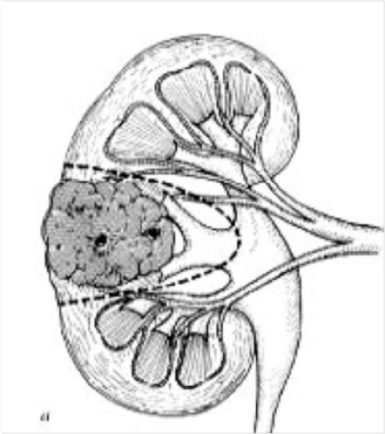 cancer-rein-1