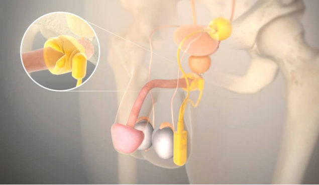 incontinence-3