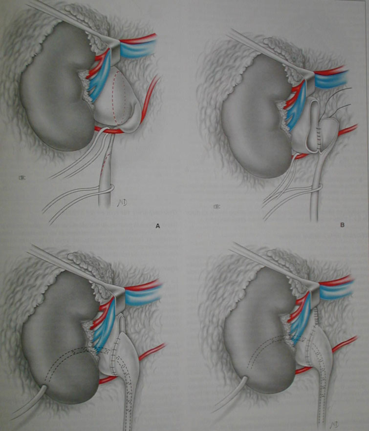 Syndrome de la jonction pyélourétérale Urologie Marseille Syndrome de la jonction pyélourétérale Urologie Marseille