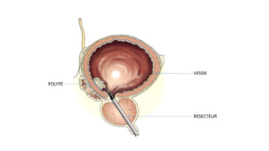 polype-sup-vessie-2