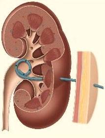 Pose d'une sonde urinaire - Revinax