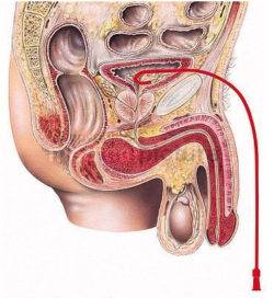 cystocatheter